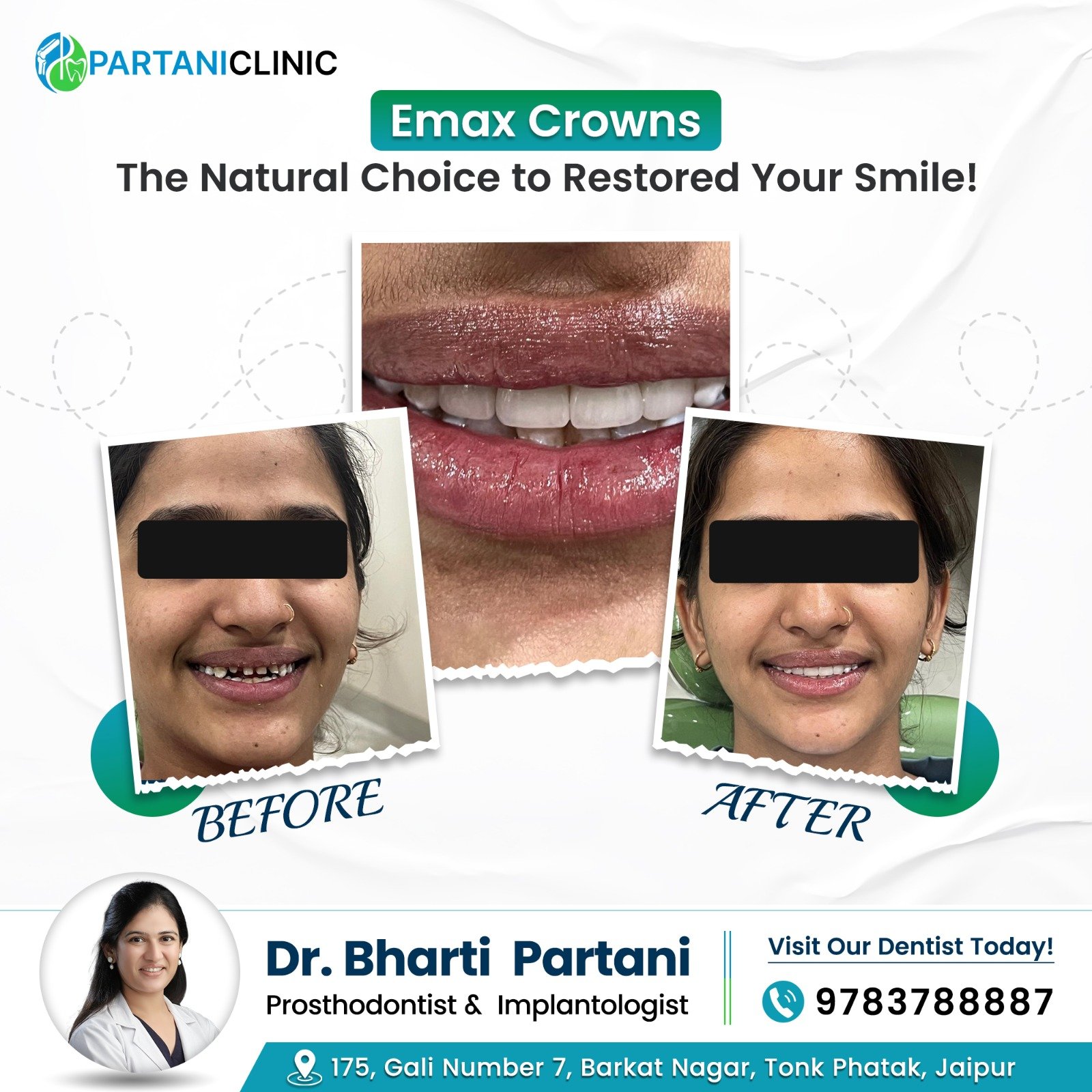 E-max crowns before and after