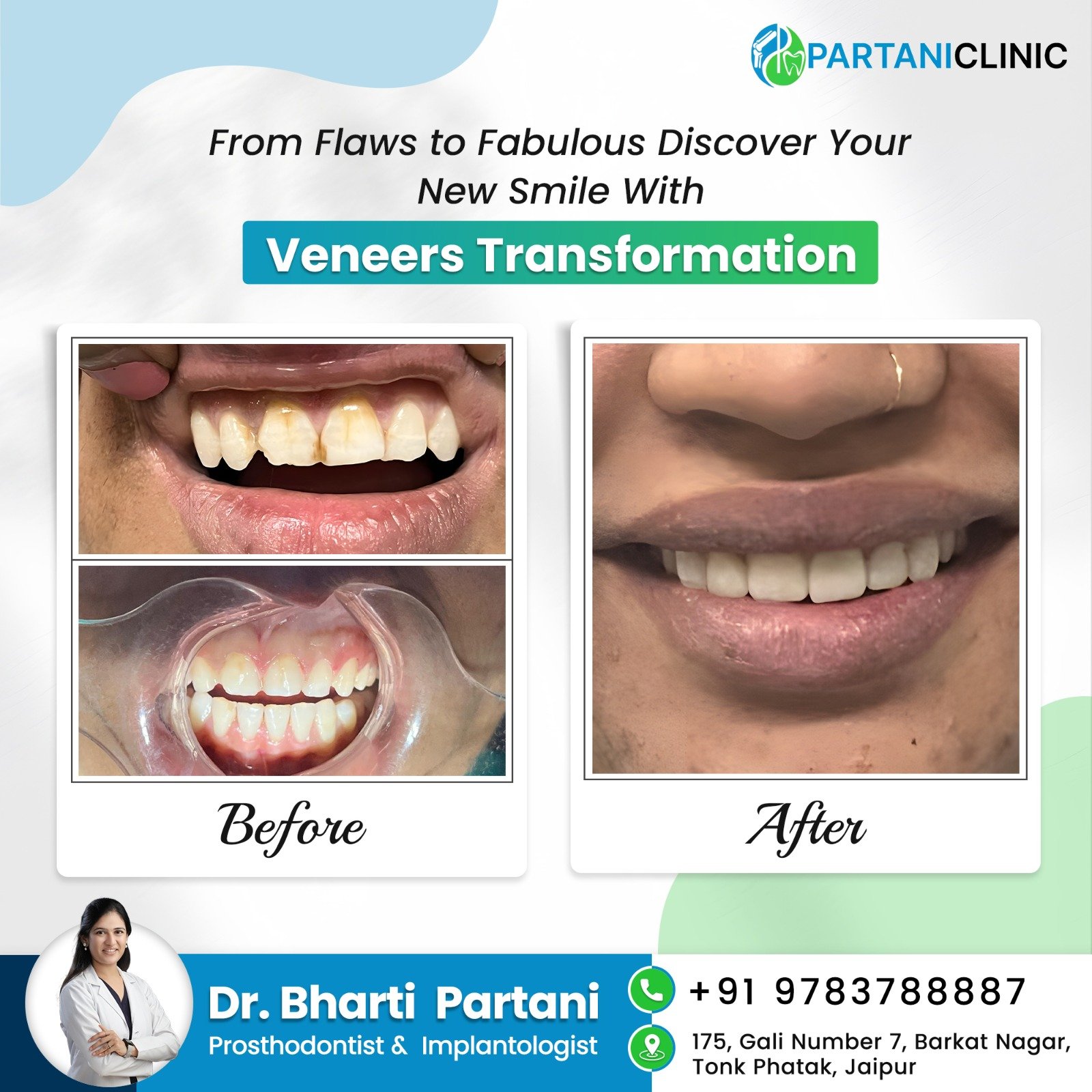 Veneers transformation before and after