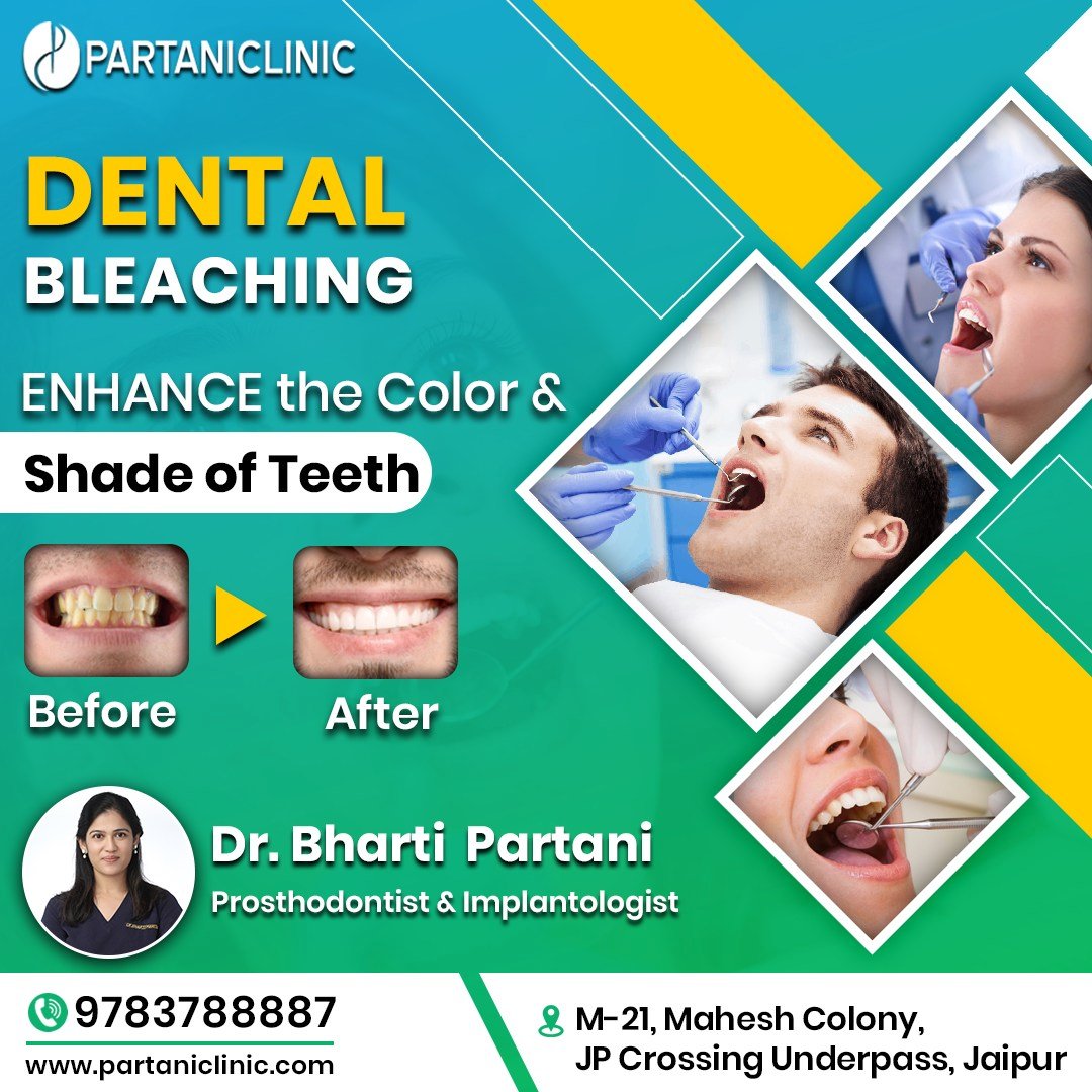 Dental bleaching whitening