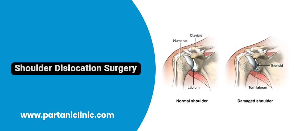 Shoulder Dislocation Surgery in Jaipur
