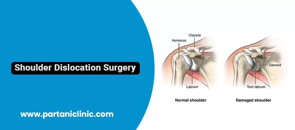 Shoulder Dislocation Surgery in Jaipur