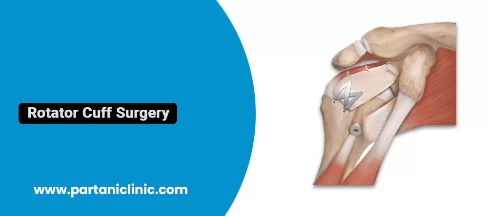 Rotator Cuff Surgery in Jaipur