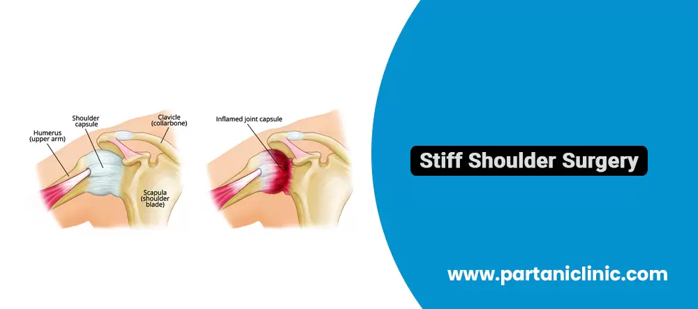 Stiff Shoulder Surgery