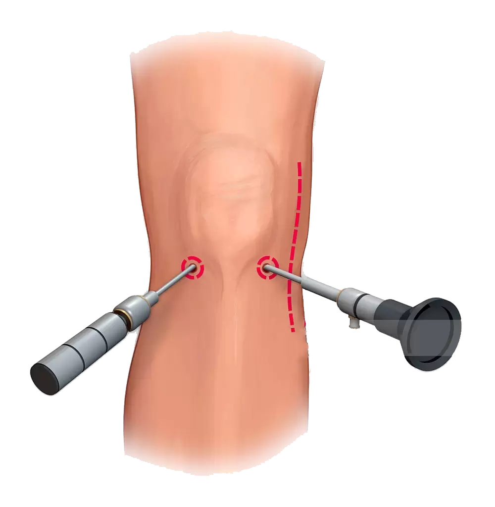 What Happens During a Knee Arthroscopy?