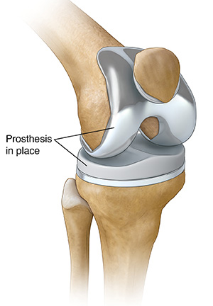 Fast Track Knee Replacement