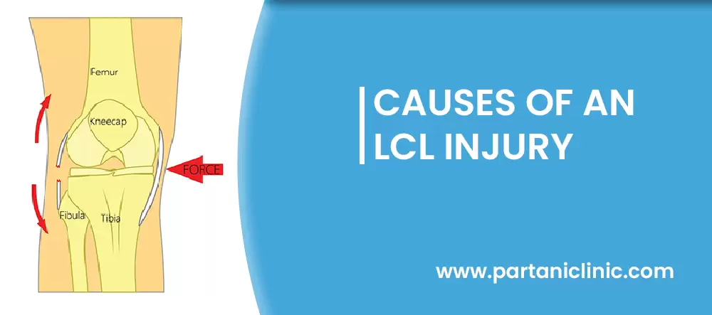 Causes of LCL