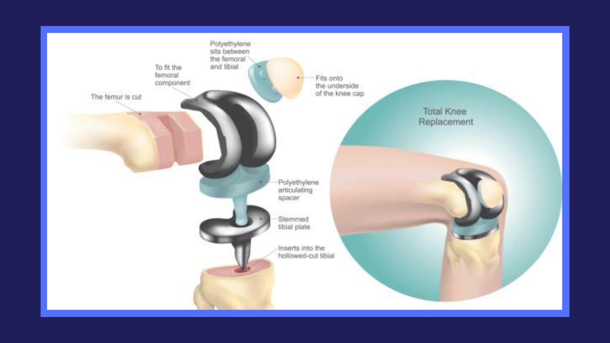 Knee Arthroscopic vs Knee Replacement in [2022] Advice from a Surgeon