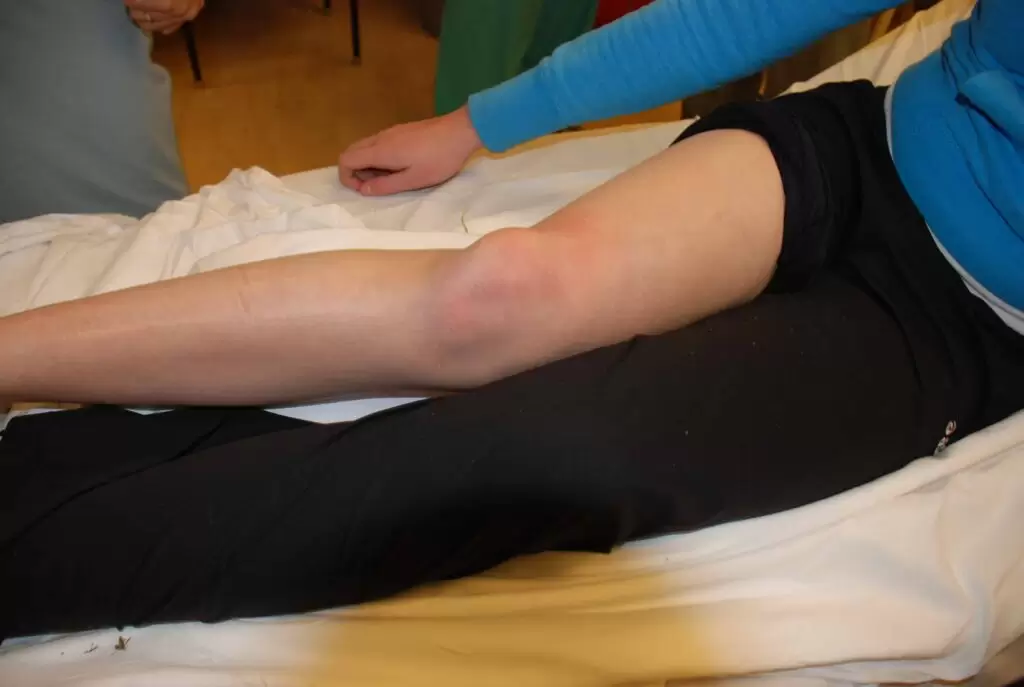 dislocated knee hindi