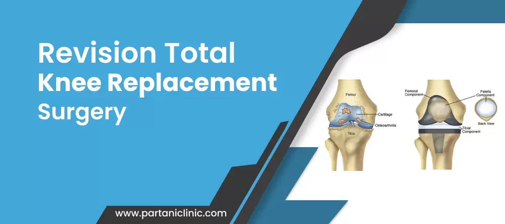 Rivision TotalKnee Replacement Surgery in Jaipur