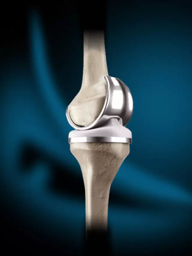 Total Knee Replacement : टोटल नी रिप्लेसमेंट क्या है?