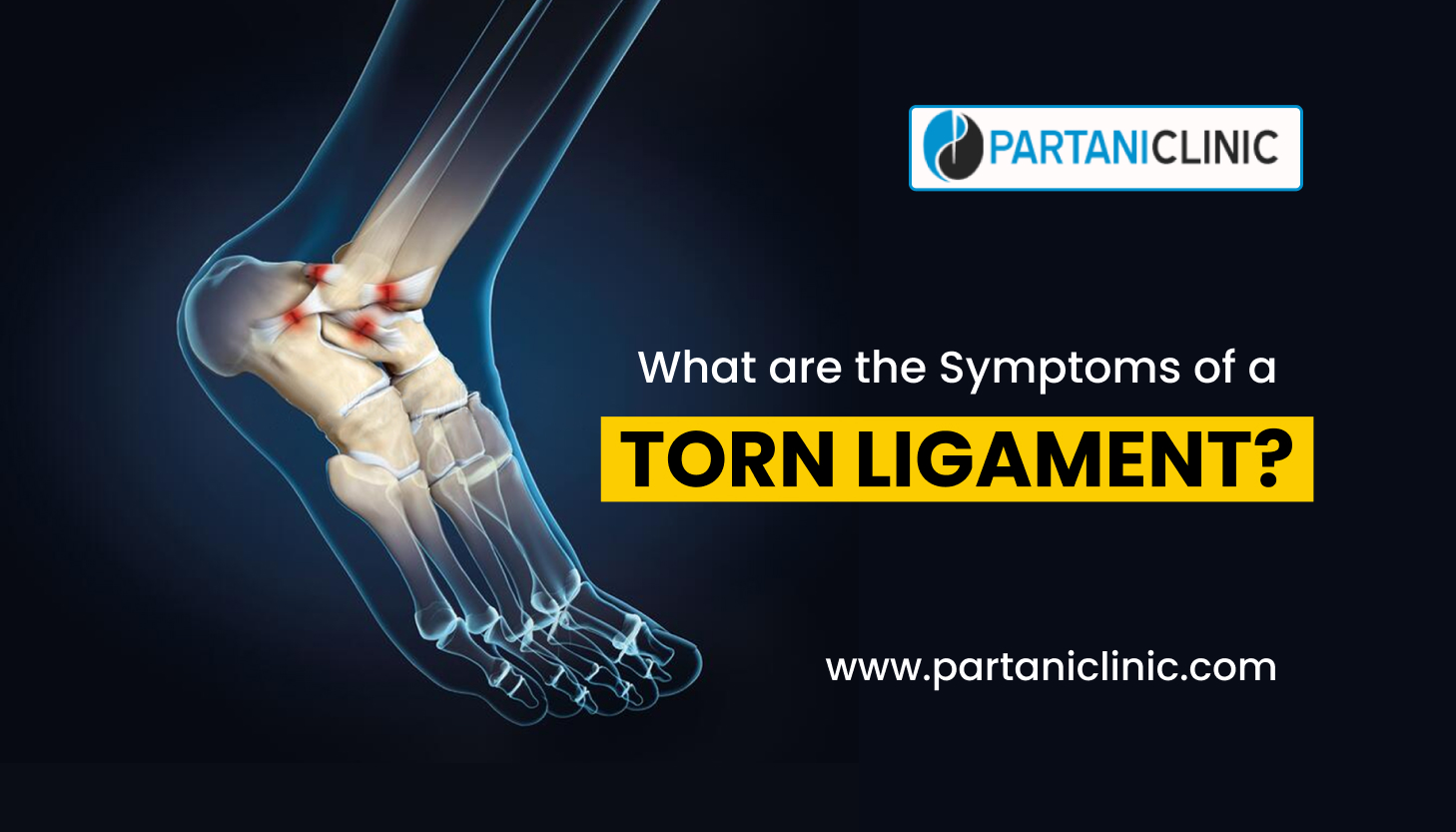 symptoms of a Torn Ligament