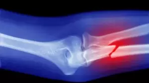 Fractures