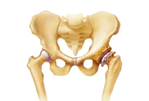hip osteoarthritis