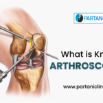 What is knee Arthroscopy