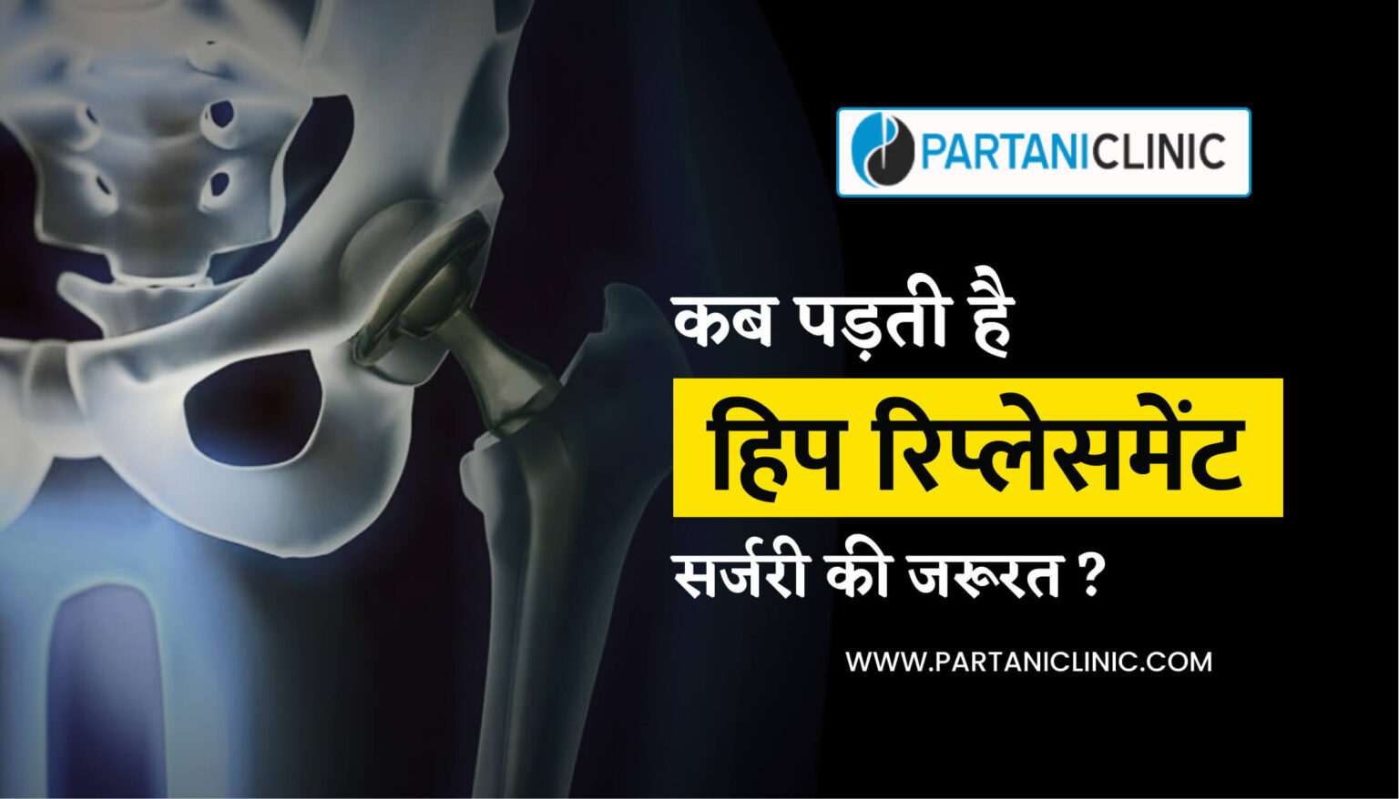 When hip replacement surgery is required सर्जरी की कब पड़ती है जरूरत?