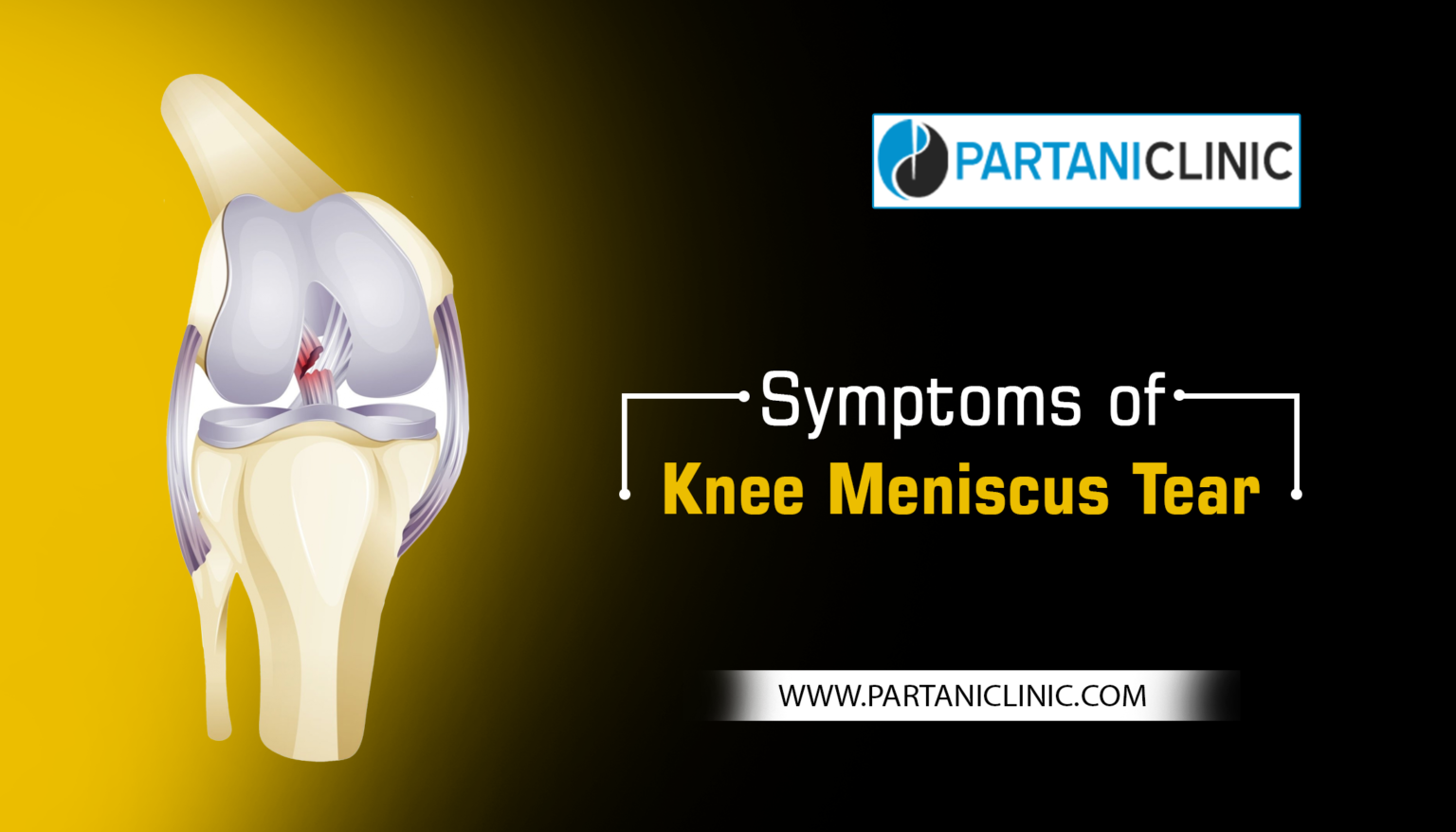 8 Main Symptoms of Knee Meniscus Tear Dr. Arun Partani