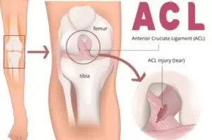 ACL Injuries