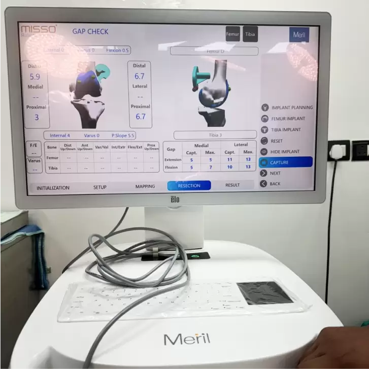 robotic-knee-replacement