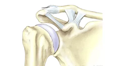 AC Joint Dislocation