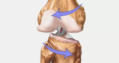 ACL Tear