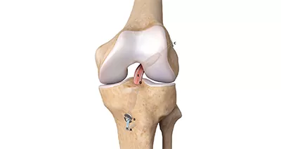 ACL Reconstruction