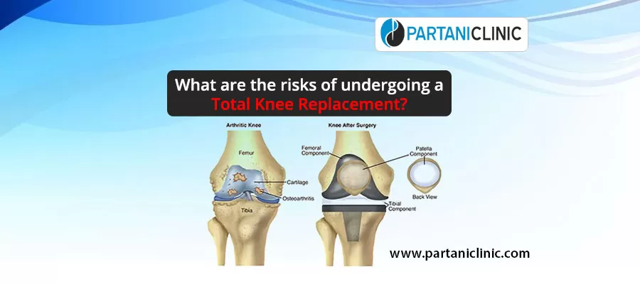 total knee replacement