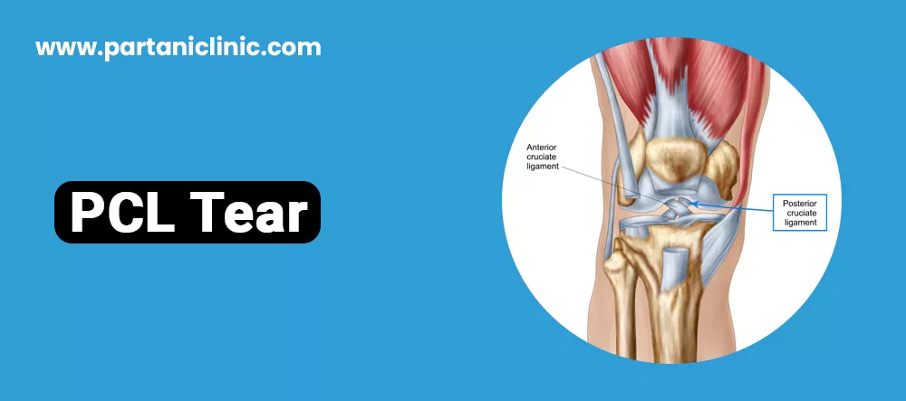 PCL Tear surgery in Jaipur