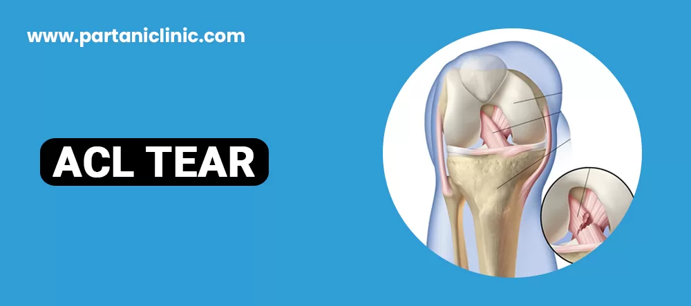 ACL Tear Surgery in Jaipur