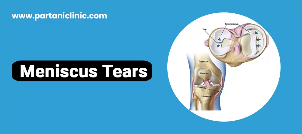 Meniscus Tear Surgery in Jaipur
