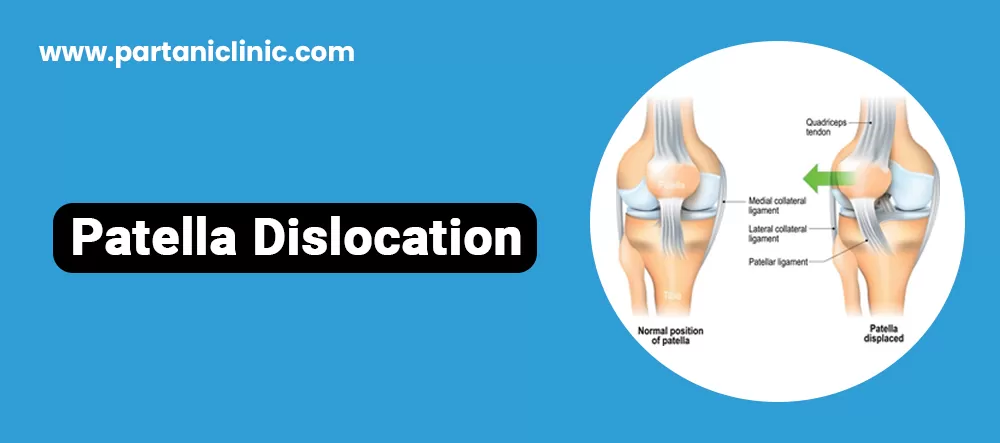 Patella Dislocation Surgery in Jaipur
