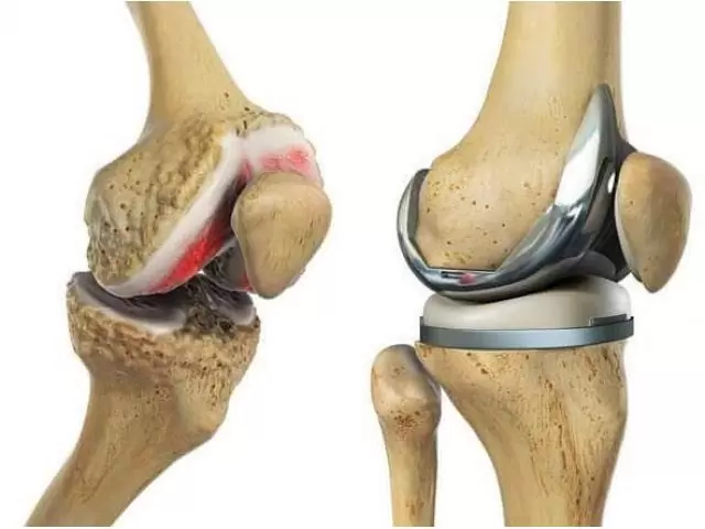 Knee Replacement Surgeon in Malviya Nagar