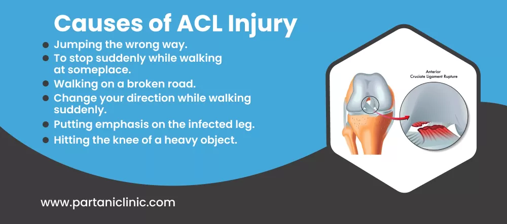ACL Tear causes