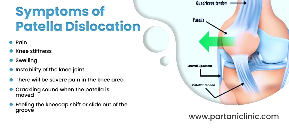 Symptoms of Patella Dislocation