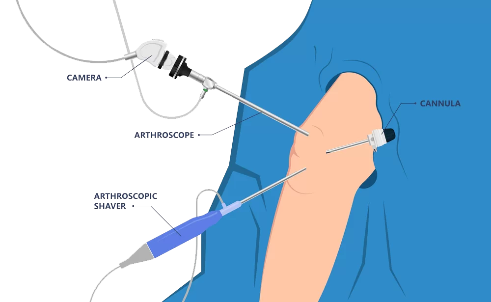 Knee Arthroscopy