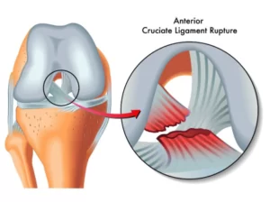 ACL & PCL Injuries
