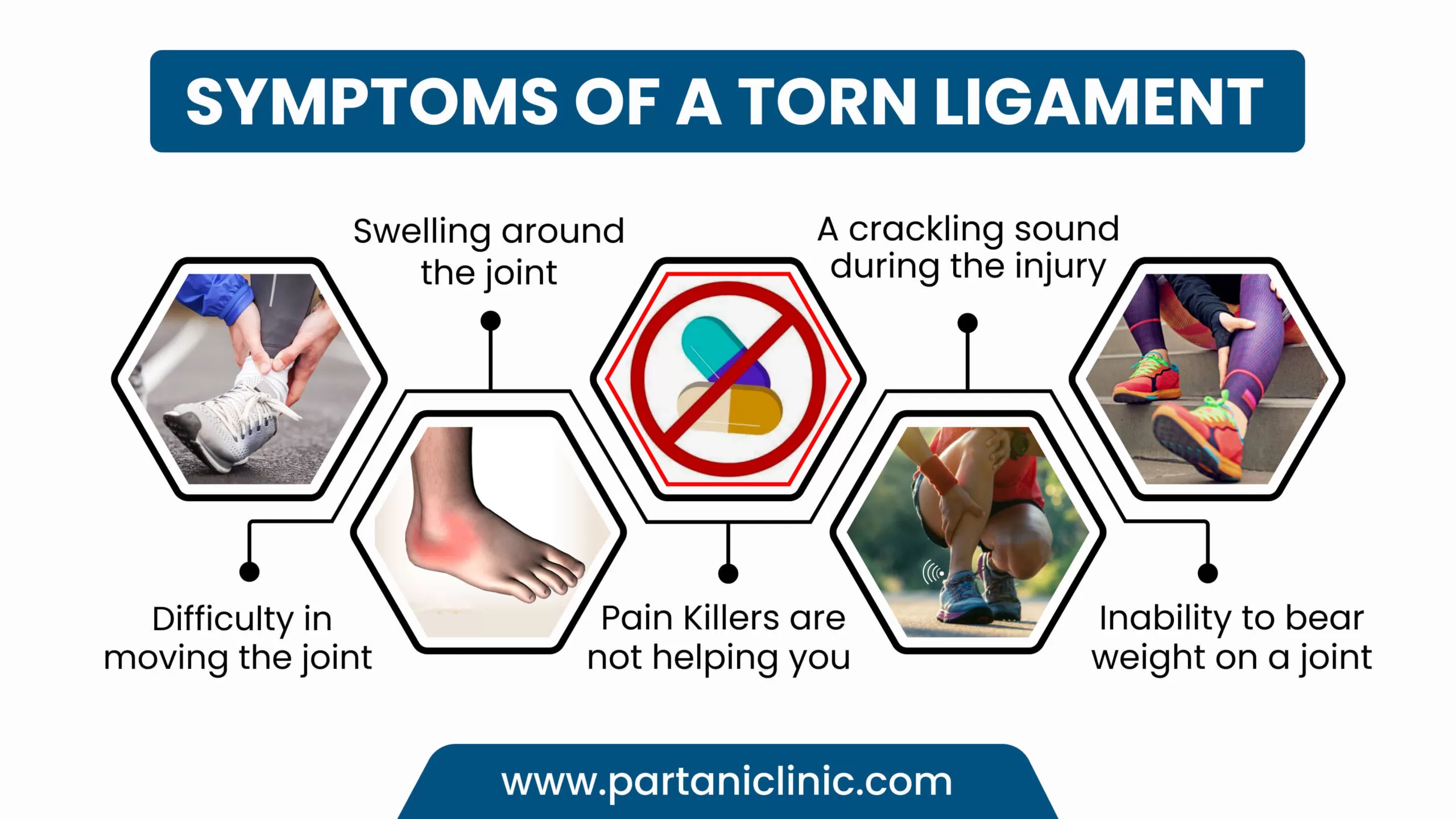 symptoms of a Torn Ligament