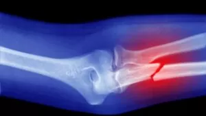 Fractures
