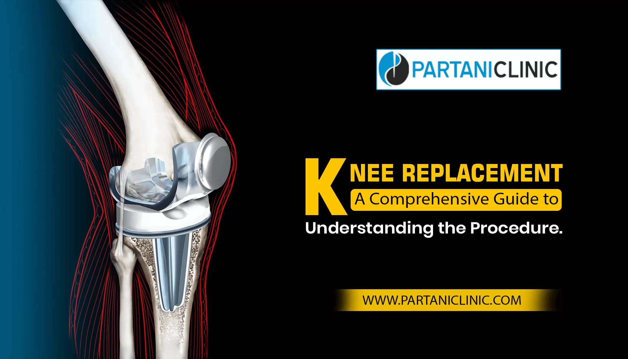 Knee Replacement Surgery Guide