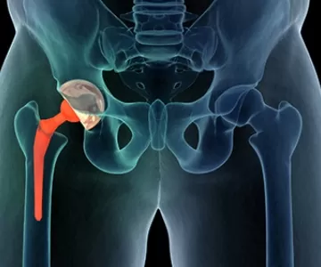 causes-hip-replacement