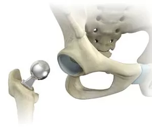 half-hip-replacement