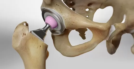 hip-replacement-overview