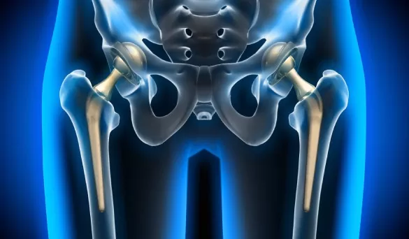 hip-replacement -surgery