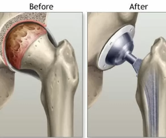 hip replacement surgery in Jaipur