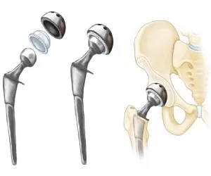 total-hip-replacement