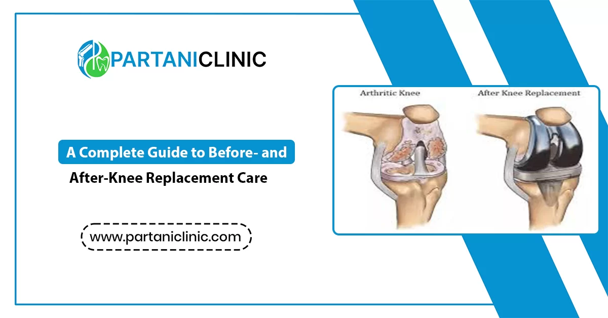 Knee Replacement Care